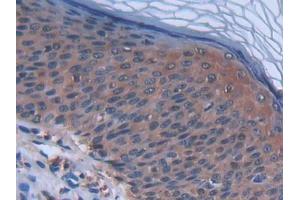 IHC-P analysis of Human Skin cancer Tissue, with DAB staining. (CCL27 anticorps  (AA 25-112))