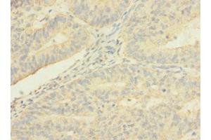Immunohistochemistry of paraffin-embedded human endometrial cancer using ABIN7173241 at dilution of 1:100 (TMEM56 anticorps  (AA 232-263))
