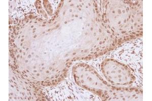 IHC-P Image Immunohistochemical analysis of paraffin-embedded Cal27 xenograft , using ML-IAP, antibody at 1:100 dilution.