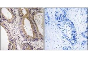 Immunohistochemistry analysis of paraffin-embedded human colon carcinoma tissue, using STK24 Antibody. (STK24 anticorps  (AA 319-368))