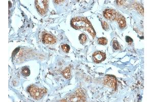 Formalin-fixed, paraffin-embedded human Breast Carcinoma stained with Laminin Receptor Monospecific Mouse Monoclonal Antibody (RPSA/2699).