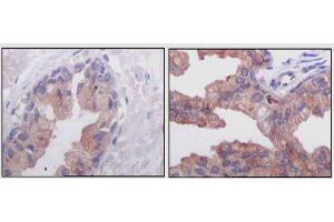 Immunohistochemical analysis of paraffin-embedded human normal prostate tissues (left) and prostate adenocarcinoma tissues (right), showing cytoplasmic localization using AMACR mouse mAb with DAB staining. (AMACR anticorps)