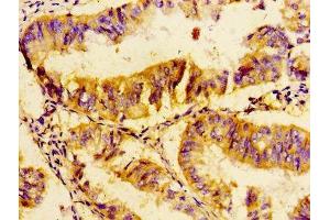Immunohistochemistry of paraffin-embedded human endometrial cancer using ABIN7174438 at dilution of 1:100