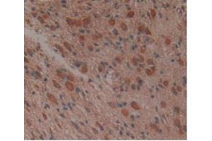 IHC-P analysis of Human Glioma Tissue, with DAB staining. (APOA1BP anticorps  (AA 118-282))