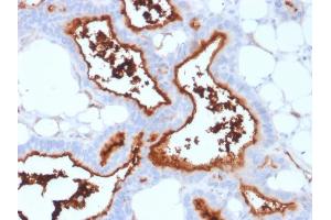 Formalin-fixed, paraffin-embedded human Lung Carcinoma stained with CD73 Mouse Monoclonal Antibody (NT5E/2503).