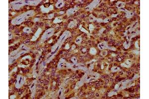 IHC image of ABIN7175529 diluted at 1:200 and staining in paraffin-embedded human liver cancer performed on a Leica BondTM system. (VKORC1 anticorps  (AA 30-74))