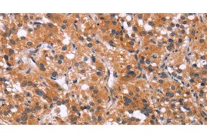 Immunohistochemistry of paraffin-embedded Human thyroid cancer using MAPK11 Polyclonal Antibody at dilution of 1:30 (MAPK11 anticorps)
