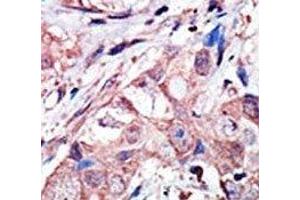 IHC analysis of FFPE human breast carcinoma tissue stained with the JNK3 antibody