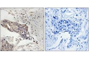 Immunohistochemistry analysis of paraffin-embedded human breast carcinoma tissue, using SLP-76 (Ab-128) Antibody.