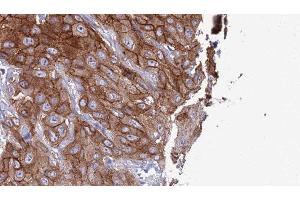 ABIN6277320 at 1/100 staining Human Head and neck cancer tissue by IHC-P. (CLEC4A anticorps  (C-Term))