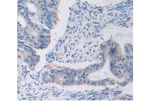 Detection of TFR in Human Rectum Cancer Tissue using Anti-Transferrin Receptor (TFR) Polyclonal Antibody (Transferrin Receptor anticorps  (AA 567-744))
