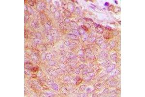 Immunohistochemical analysis of Copine 8 staining in human breast cancer formalin fixed paraffin embedded tissue section. (CPNE8 anticorps  (N-Term))