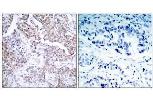 Immunohistochemical analysis of paraffin-embedded human breast carcinoma tissue using p53 (phospho- Ser15) antibody (E011094). (p53 anticorps  (pSer15))