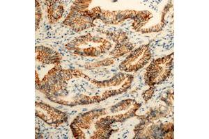 Immunohistochemical analysis of PEX11B staining in human colon cancer formalin fixed paraffin embedded tissue section. (PEX11B anticorps  (Center))