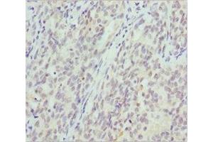 Immunohistochemistry of paraffin-embedded human lung cancer using ABIN7145471 at dilution of 1:100 (CRYGS anticorps  (AA 1-178))