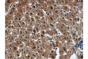 Immunohistochemical staining of paraffin-embedded Adenocarcinoma of Human endometrium tissue using anti-QPRT mouse monoclonal antibody. (QPRT anticorps)
