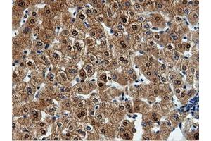 Immunohistochemical staining of paraffin-embedded Adenocarcinoma of Human endometrium tissue using anti-QPRT mouse monoclonal antibody.