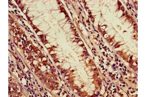 Immunohistochemistry of paraffin-embedded human colon cancer using ABIN7169756 at dilution of 1:100 (PDS5A anticorps  (AA 2-134))