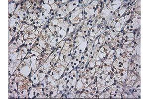 Immunohistochemical staining of paraffin-embedded Carcinoma of Human kidney tissue using anti-RASSF1 mouse monoclonal antibody. (RASSF1 anticorps)