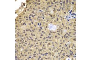 Immunohistochemistry of paraffin-embedded human well-differentiated squamous skin carcinoma using CCNA2 antibody. (Cyclin A anticorps)