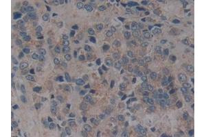 Detection of CD40 in Human Prostate cancer Tissue using Polyclonal Antibody to Tumor Necrosis Factor Receptor Superfamily, Member 5 (CD40)