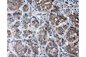 Immunohistochemical staining of paraffin-embedded Carcinoma of liver tissue using anti-LIPG mouse monoclonal antibody. (LIPG anticorps)