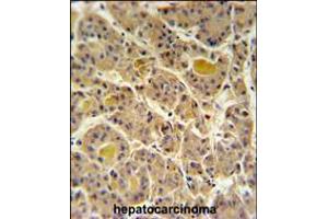 IN80D Antibody IHC analysis in formalin fixed and paraffin embedded human hepatocarcinoma followed by peroxidase conjugation of the secondary antibody and DAB staining. (IN80D anticorps  (N-Term))