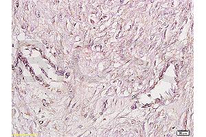 Formalin-fixed and paraffin embedded human cervical carcinoma labeled Anti-FGFR4 Polyclonal Antibody, Unconjugated (ABIN671766) at 1:200, followed by conjugation to the secondary antibody and DAB staining