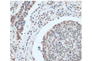 Immunohistochemistry of paraffin-embedded Human lung cancer using ZNF433 Polyclonal Antibody at dilution of 1:100 (40x lens). (ZNF433 anticorps)