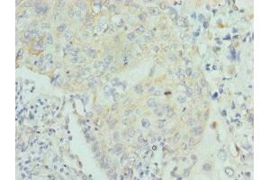 Immunohistochemistry of paraffin-embedded human lung cancer using ABIN7158582 at dilution of 1:100 (LUM anticorps  (AA 19-338))