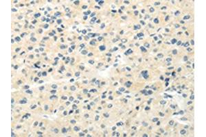 The image on the left is immunohistochemistry of paraffin-embedded Human liver cancer tissue using ABIN7193018(VIPR1 Antibody) at dilution 1/20, on the right is treated with synthetic peptide. (VIPR1 anticorps)