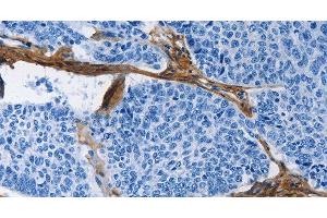 Immunohistochemistry of paraffin-embedded Human lung cancer tissue using COL3A1 Polyclonal Antibody at dilution 1:60
