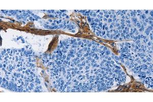 Immunohistochemistry of paraffin-embedded Human lung cancer tissue using COL3A1 Polyclonal Antibody at dilution 1:60 (COL3A1 anticorps)