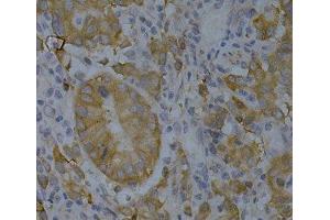 Immunohistochemistry of paraffin-embedded Human gastric cancer using BIN1 Polyclonal Antibody at dilution of 1:200 (40x lens).