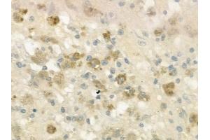 ABIN6262491 and ABIN6269118 at 1/100 staining human melanoma by IHC-P.