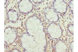 Immunohistochemistry of paraffin-embedded human colon cancer using ABIN7160702 at dilution of 1:100 (GCNT2 anticorps  (AA 203-402))