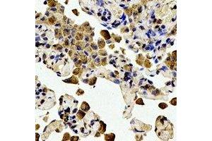 Immunohistochemical analysis of BCL2 (pT56) staining in human lung cancer formalin fixed paraffin embedded tissue section. (Bcl-2 anticorps  (pSer56))