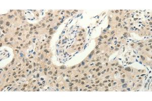 Immunohistochemistry of paraffin-embedded Human lung cancer tissue using Frizzled 10 Polyclonal Antibody at dilution 1:50 (FZD10 anticorps)