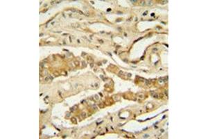 Immunohistochemistry analysis in formalin fixed and paraffin embedded human lung tissue reacted with NDUF3 Antibody (N-term) followed which was peroxidase conjugated to the secondary antibody and  followed by DAB staining. (NDUFAF3 anticorps  (N-Term))