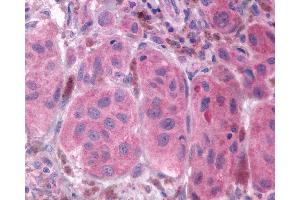 Anti-FP / PTGFR antibody IHC of human Skin, Melanoma.