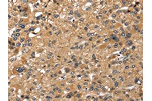 The image on the left is immunohistochemistry of paraffin-embedded Human liver cancer tissue using ABIN7191289(LONP1 Antibody) at dilution 1/25, on the right is treated with synthetic peptide. (LONP1 anticorps)