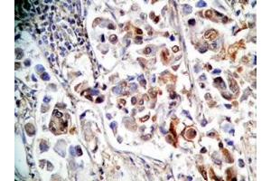 Human stomach cancer tissue was stained by rabbit anti-Spexin(H) Antiserum (Spexin anticorps)