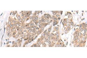Immunohistochemistry of paraffin-embedded Human thyroid cancer tissue using M1AP Polyclonal Antibody at dilution of 1:80(x200) (Meiosis 1 Associated Protein (M1AP) anticorps)