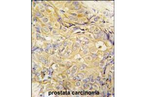 Formalin-fixed and paraffin-embedded human prostata carcinoma tissue reacted with FGF10 antibody , which was peroxidase-conjugated to the secondary antibody, followed by DAB staining. (FGF10 anticorps  (C-Term))