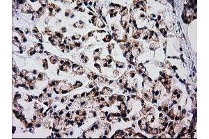 Immunohistochemical staining of paraffin-embedded Adenocarcinoma of Human colon tissue using anti-FAM127C mouse monoclonal antibody. (FAM127C anticorps)