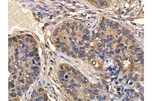 FMR1 Mouse Monoclonal Antibody at 1/100 staining human lung cancer and adjacent non-tumor tissue by IHC-P. (FMR1 anticorps  (Internal Region))