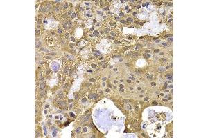 Immunohistochemistry of paraffin-embedded human oophoroma using NAA20 antibody.