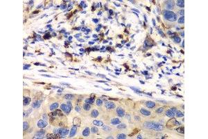 Immunohistochemistry of paraffin-embedded Human esophageal cancer using S100A8 Polyclonal Antibody at dilution of 1:100 (40x lens). (S100A8 anticorps)