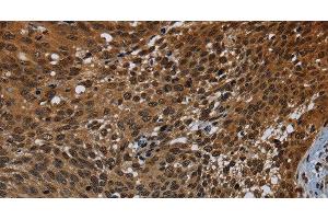 Immunohistochemistry of paraffin-embedded Human cervical cancer tissue using KDM4B Polyclonal Antibody at dilution 1:50 (KDM4B anticorps)