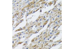 Immunohistochemistry of paraffin-embedded human liver cancer using BMP2 Rabbit pAb (ABIN3020733, ABIN3020734, ABIN1512642, ABIN1513827 and ABIN6213697) at dilution of 1:100 (40x lens). (BMP2 anticorps  (AA 283-396))